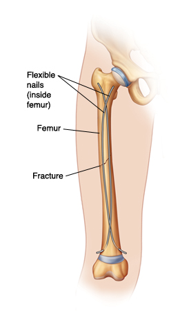 Fractur_Femur.jpg