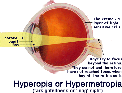 hypermetropia.png