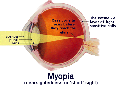 myopia.png