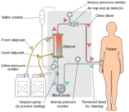 400px-Hemodialysis-en.svg.png