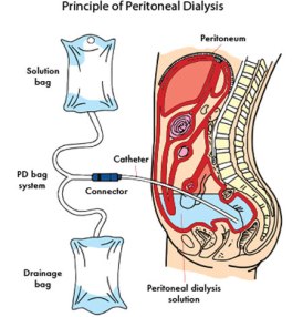 peritoneal dialysis.jpg