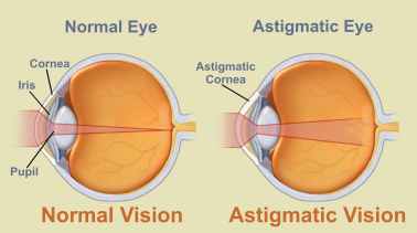 astigmatism.jpg