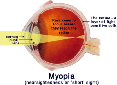 myopia.png