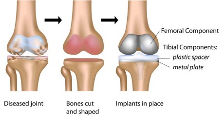 Knee replacement.2.jpg