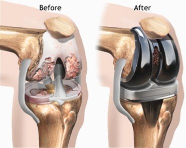 Knee replacement.3.jpg
