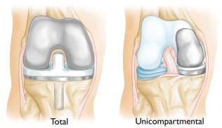Knee replacement.4.jpg